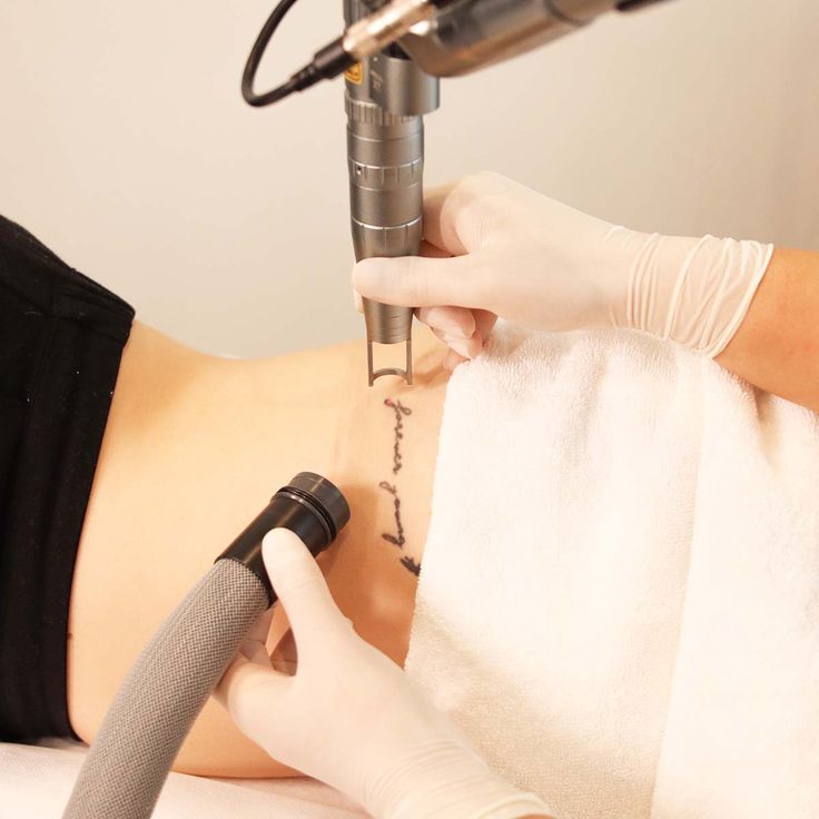 Eliminación Tatuaje